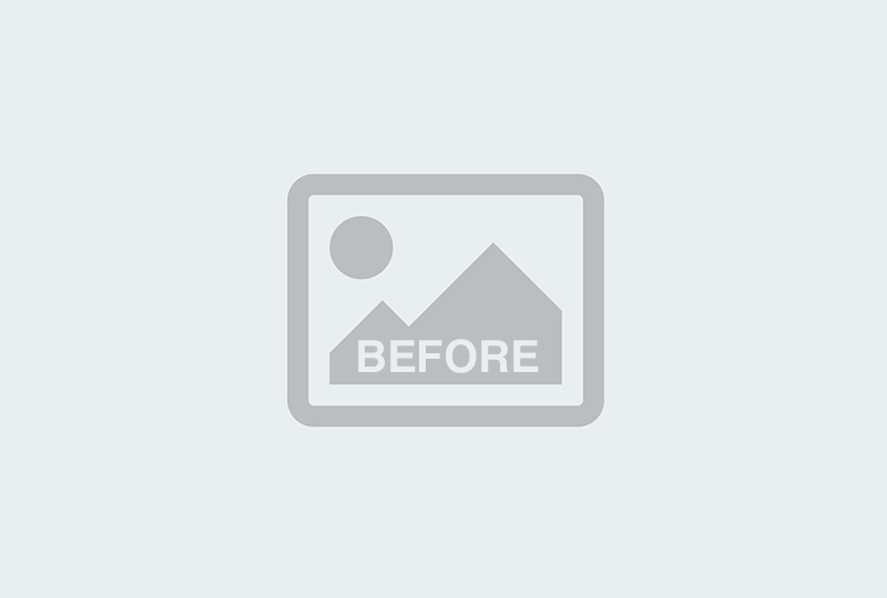 Before Image: Breast Reduction: Case 8 - front