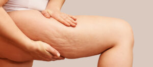 woman with excess skin and cellulite after losing a lot of weight