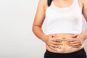 Woman pulling up loose skin on stomach which could make her a candidate for tummy tuck.