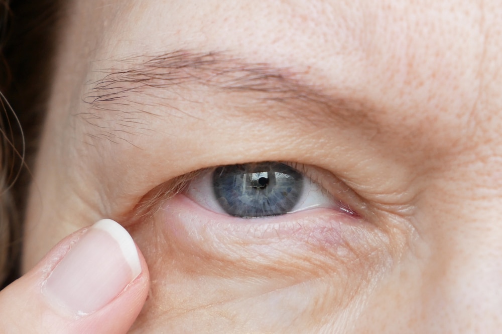 Close-up of a mature person’s lower eyelid showing puffiness and under-eye bags. Close-up of a mature person’s lower eyelid showing puffiness and under-eye bags.