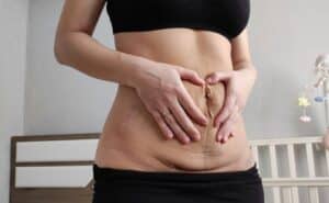 Woman touching stomach with stretched skin after pregnancy who make be good candidate for mommy makeover.