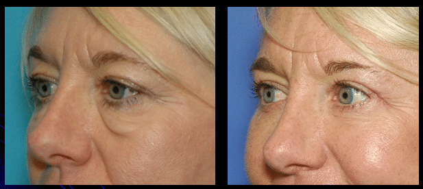 Bleph_CloseUPp2025-07-22 092911