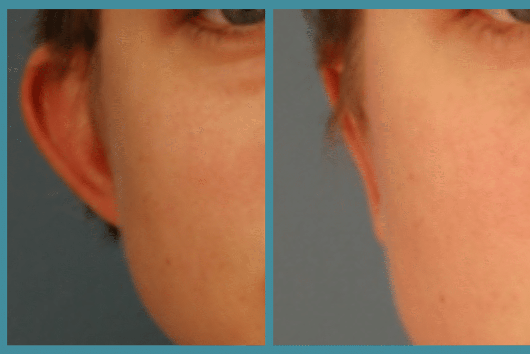 Otoplasty_Front