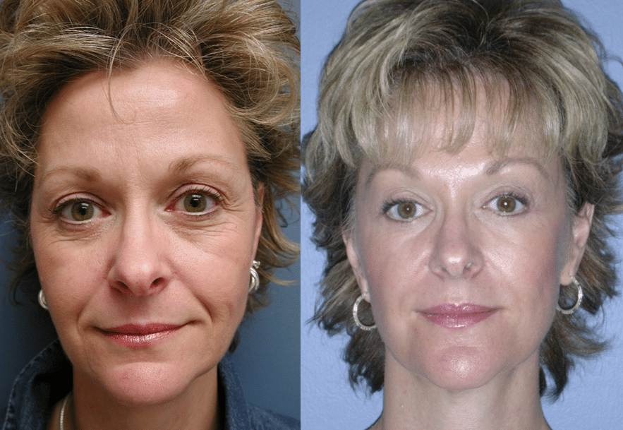 Show9_Facial Fat Grafting