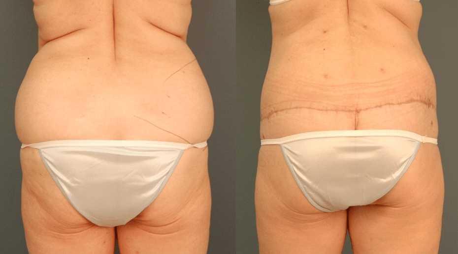 Body Lift_Back_sidebyside