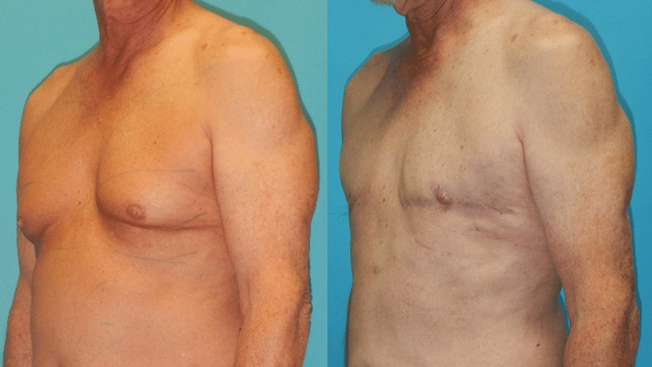 Gynecomastia_sidebyside
