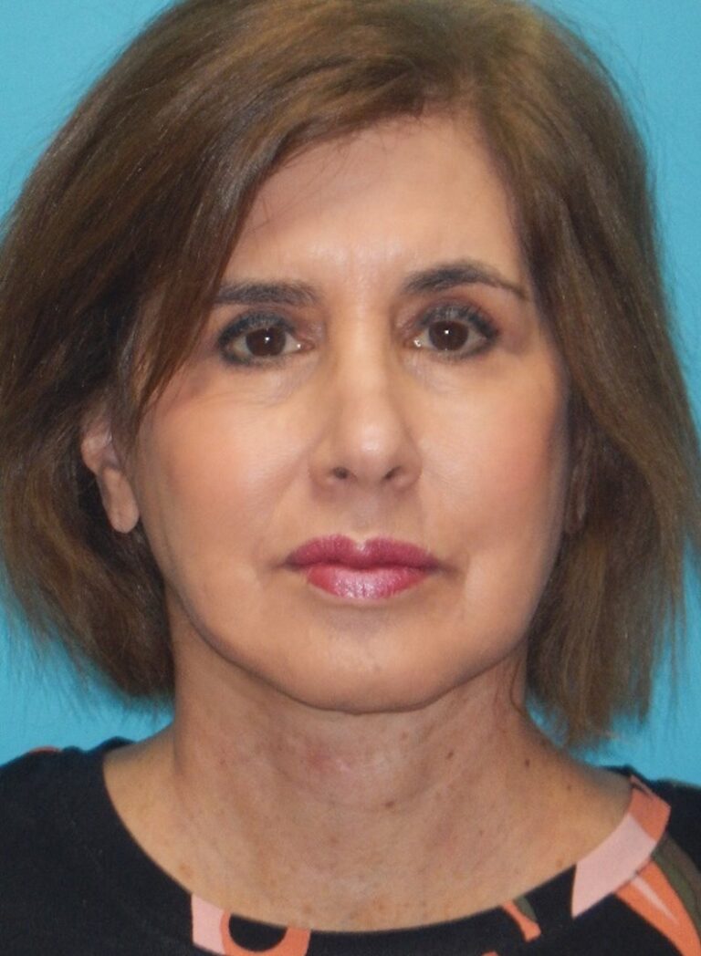 After Image: Face & Neck Lifts: Case 15 - front