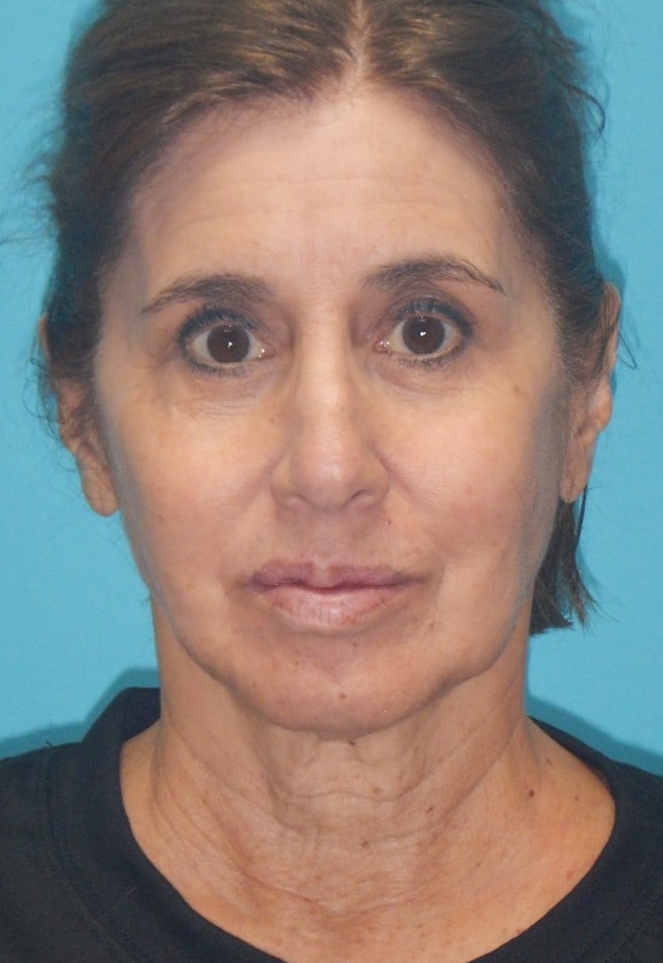 Before Image: Face & Neck Lifts: Case 15 - front
